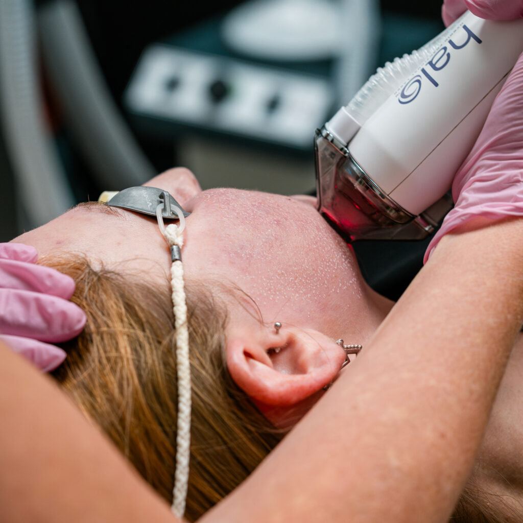 Patient receives the Halo laser resurfacing portion of the acne scar treatment process.