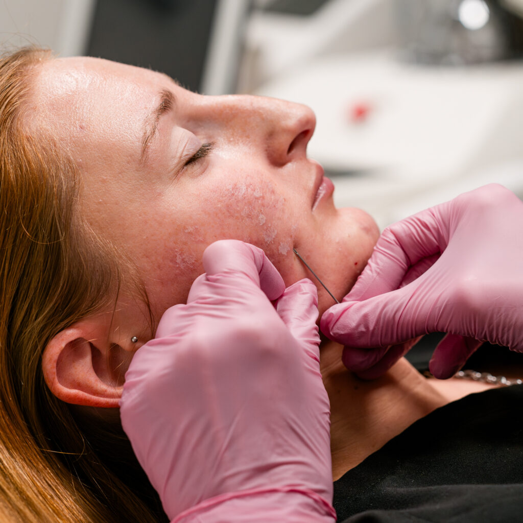 Patient is comfortable as a provider performs subcision, gently releasing scar tissue to improve the appearance of acne scars.