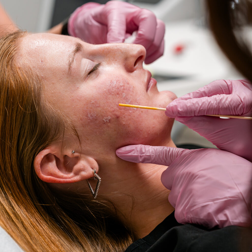 Patient lying comfortably on a treatment table at Salt Spa, receiving a TCA Peel as part of an advanced acne scar treatment to improve skin texture and tone.