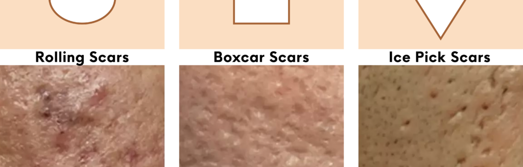 Graphic illustrating the three main types of acne scarring: rolling scars with wavy indentations, boxcar scars with defined edges, and ice pick scars with narrow, deep pits.