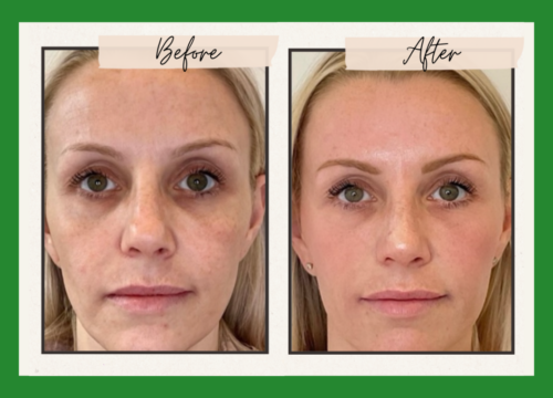 It’s a Sculptra Summer