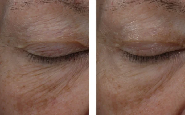 Improves the appearance of crow's feet, wrinkles, puffiness and under-eye darkness.