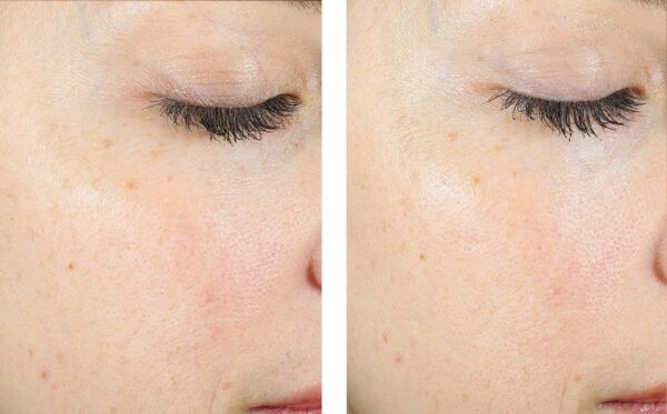AlphaRet Exfoliating Peel Pads - Image 2