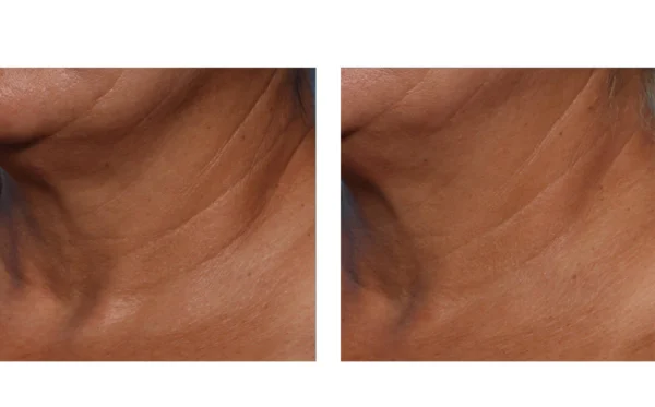 Skin can look firmer and more resilient. Improves the appearance of crepiness, laxity and texture. Intensely hydrates to improve the suppleness of the skin.
