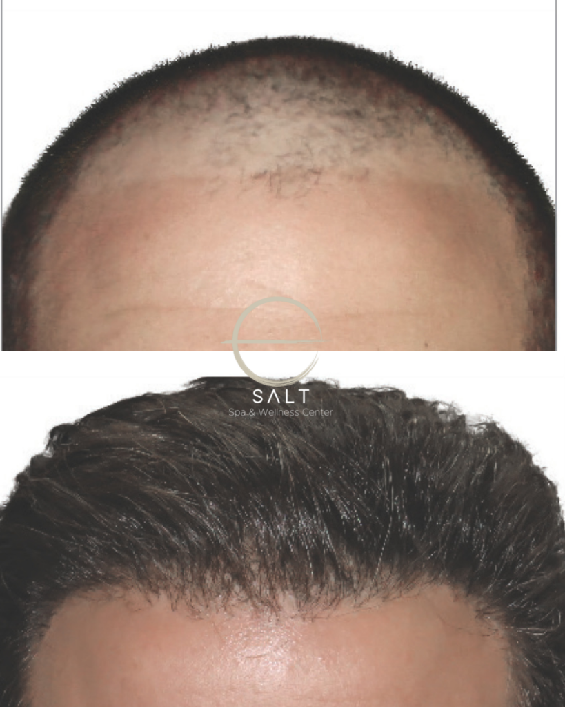 hairline loss treatmentnear me