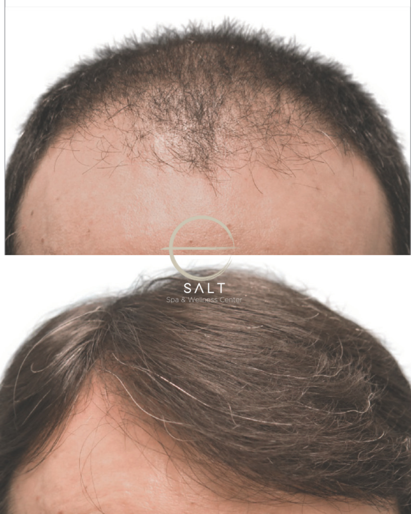 hairline loss treatment in virginia beach