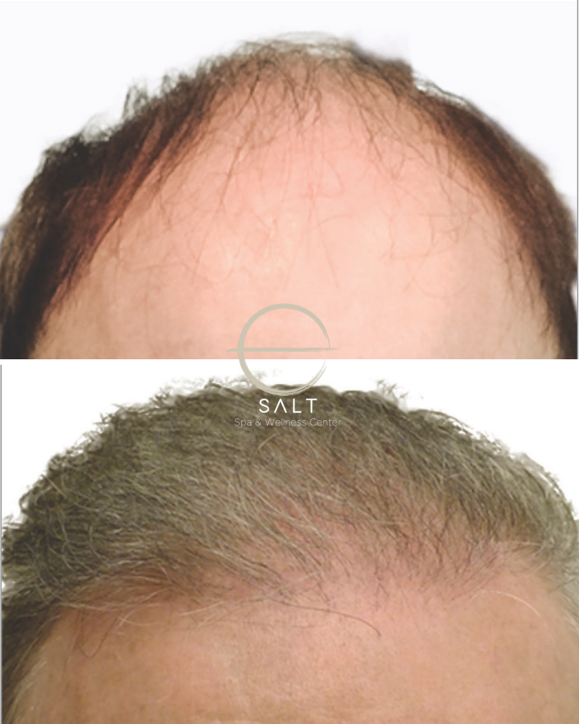 hairline loss treatment in virginia beach