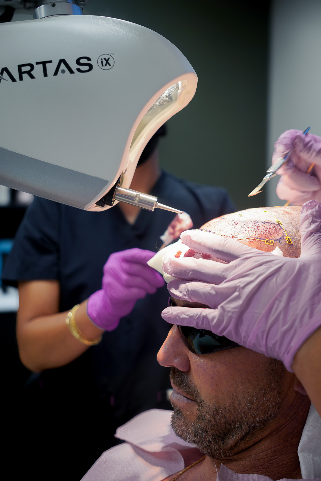 FUE Hair Transplant Systems in VA Beach: ARTAS iX vs. NeoGraft