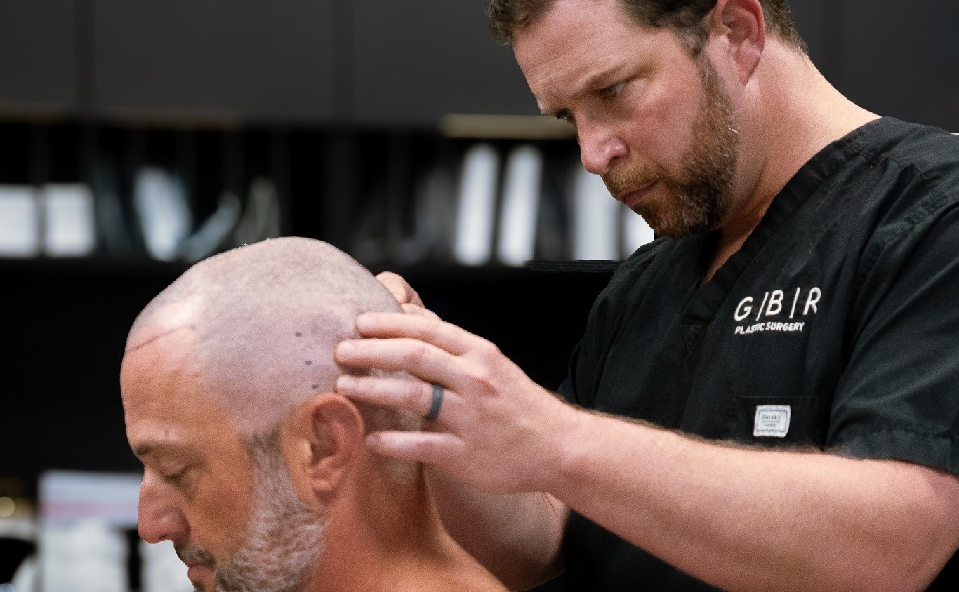 turkish hair transplant in virginia beach