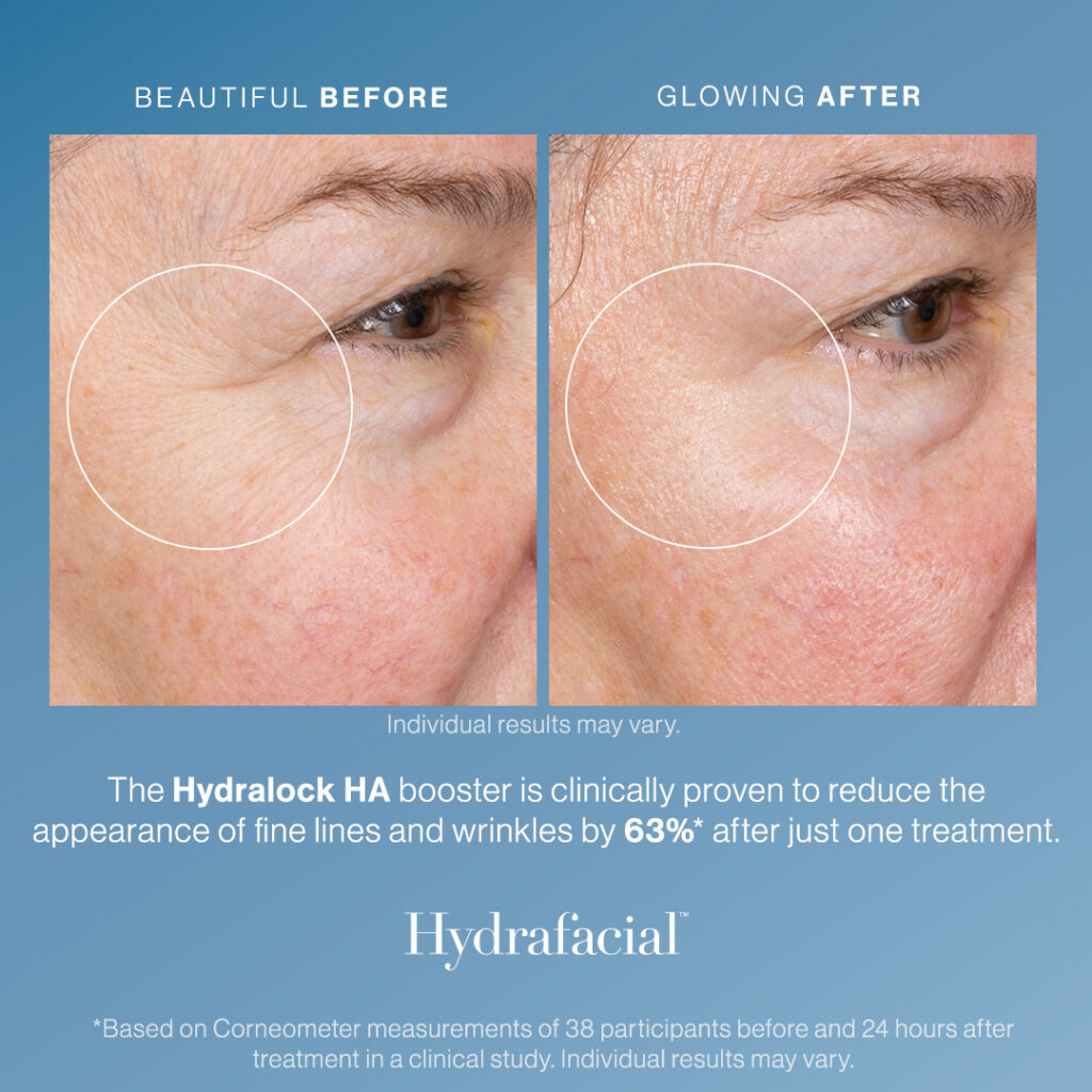 hydrafacial in virginia beach